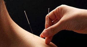 acupuncture-2